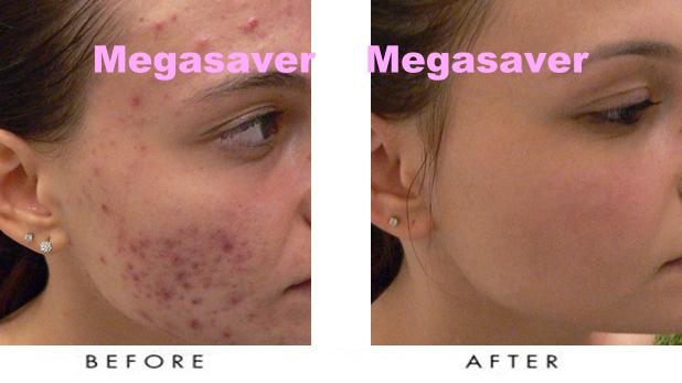 Acne facial scarring product